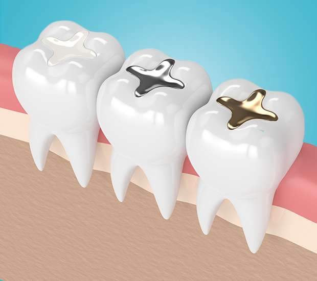Cumming Tooth Colored Fillings