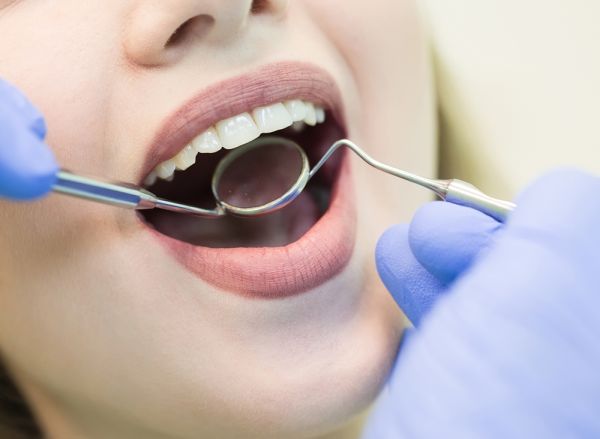 Is A Dental Filling Always Required For Cavities?