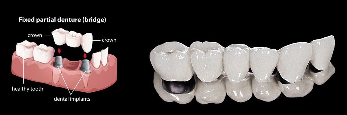 Cumming Dentures