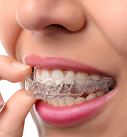Clear Aligners - Almost Invisible Braces Cumming, GA
