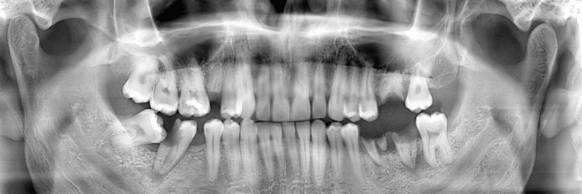 Cumming Wisdom Teeth Extraction